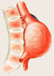 Généralités Anévrisme de l'aorte abdominale - Hopital Bichat Chirvtt