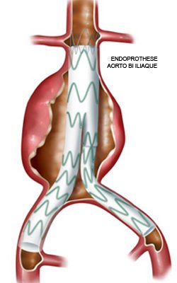 anevrisme-aorte-chirurgie-vasculaire-chirvtt-7