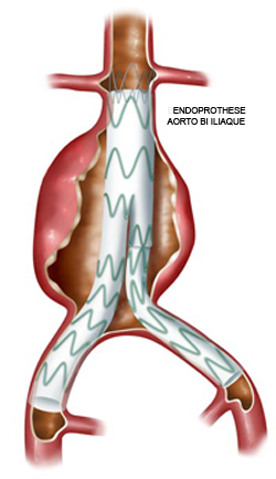 Généralités Anévrisme de l'aorte abdominale - Hopital Bichat Chirvtt