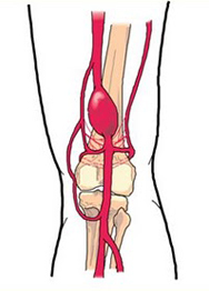 Anévrisme artère poplitée - symptôme, examen, traitement - Bichat ...