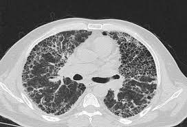 Biopsie pulmonaire thoracoscopie - Chirurgie thoracique Hopital Bichat