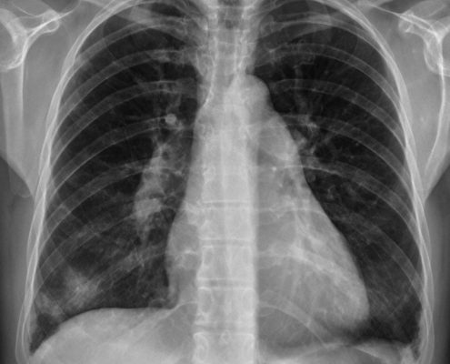 La radiographie thoracique est-elle utile dans les toux chroniques ?