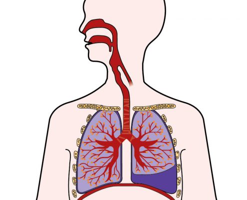 Pleuresie - Thoracoscopie - Chirurgie thoracique Hopital Bichat