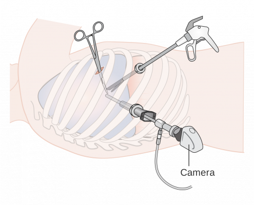 Pleuresie - Thoracoscopie - Chirurgie thoracique Hopital Bichat