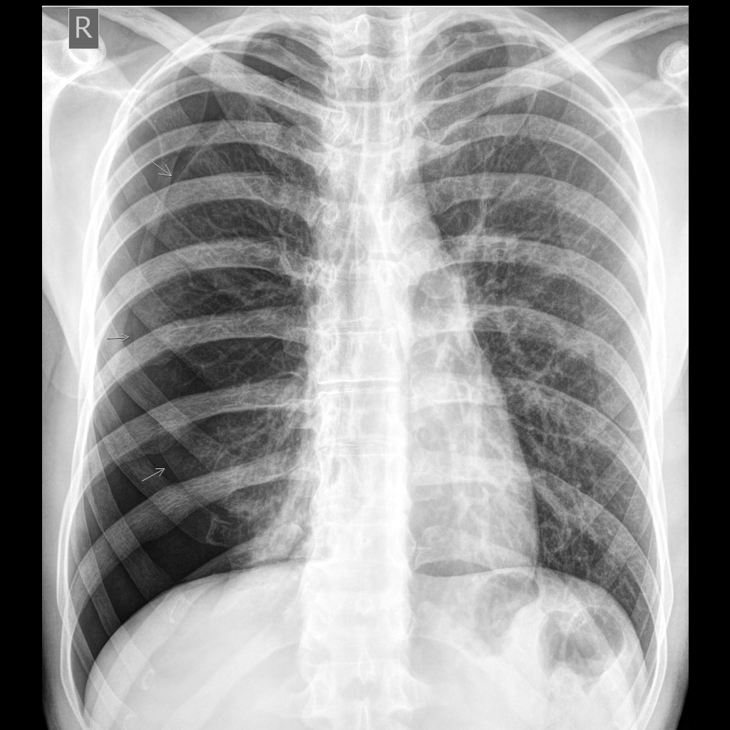 Pneumothorax – Symphyse Pleurale - Chirurgie thoracique Hop. Bichat