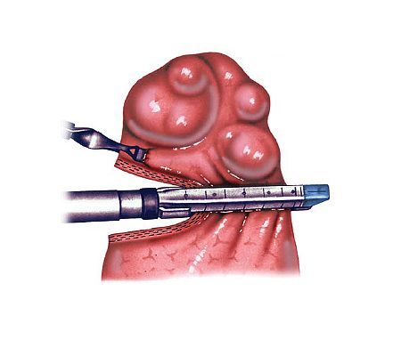 Pneumothorax – Symphyse Pleurale - Chirurgie thoracique Hop. Bichat